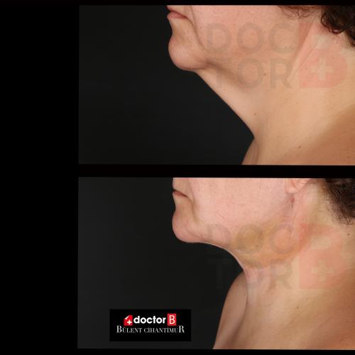 fotos antes y después de nuestros pacientes - Blefaroplastia - Dr. Çağatay Güngörsün